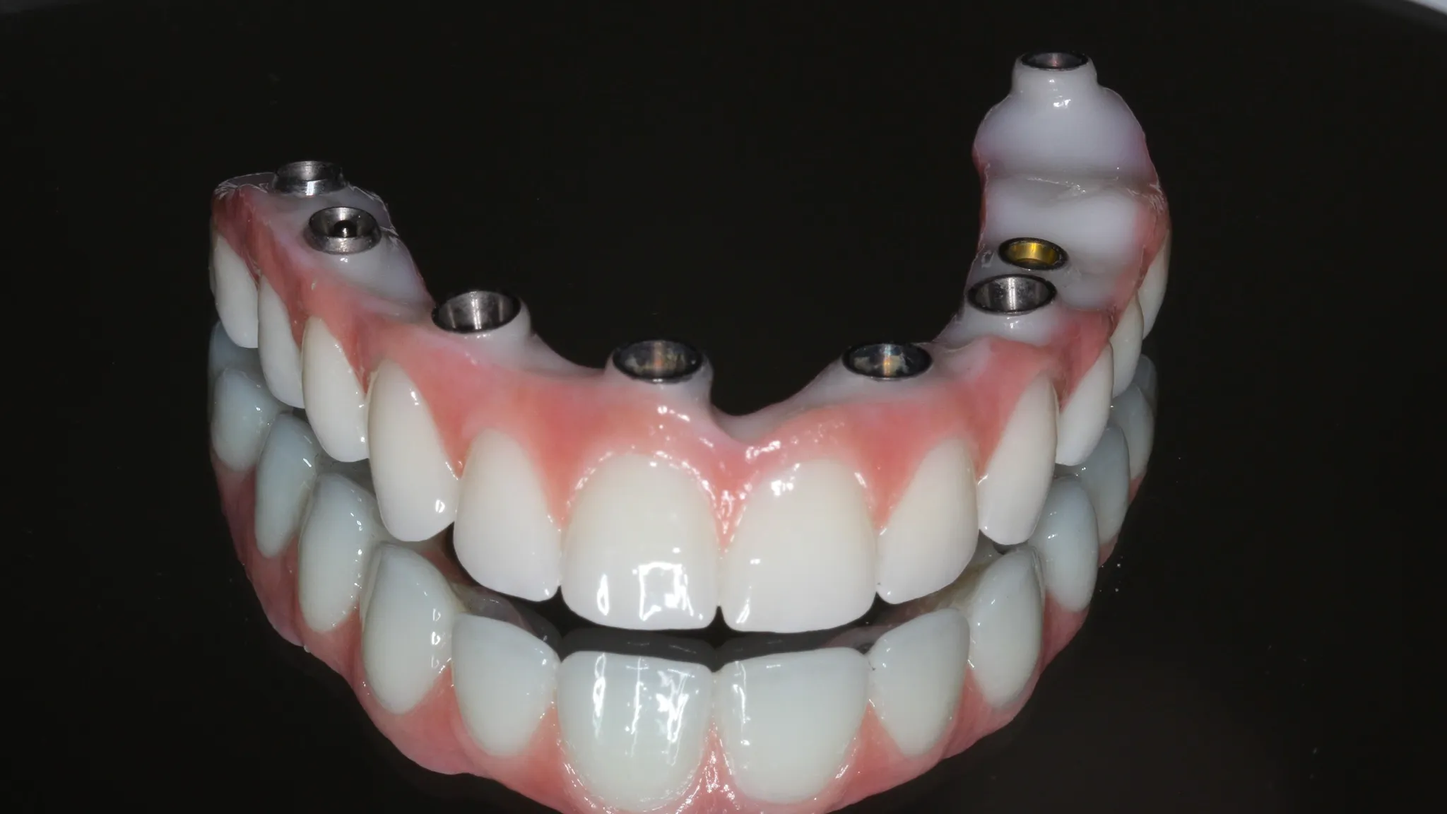 All-on-4 dental implants patient result