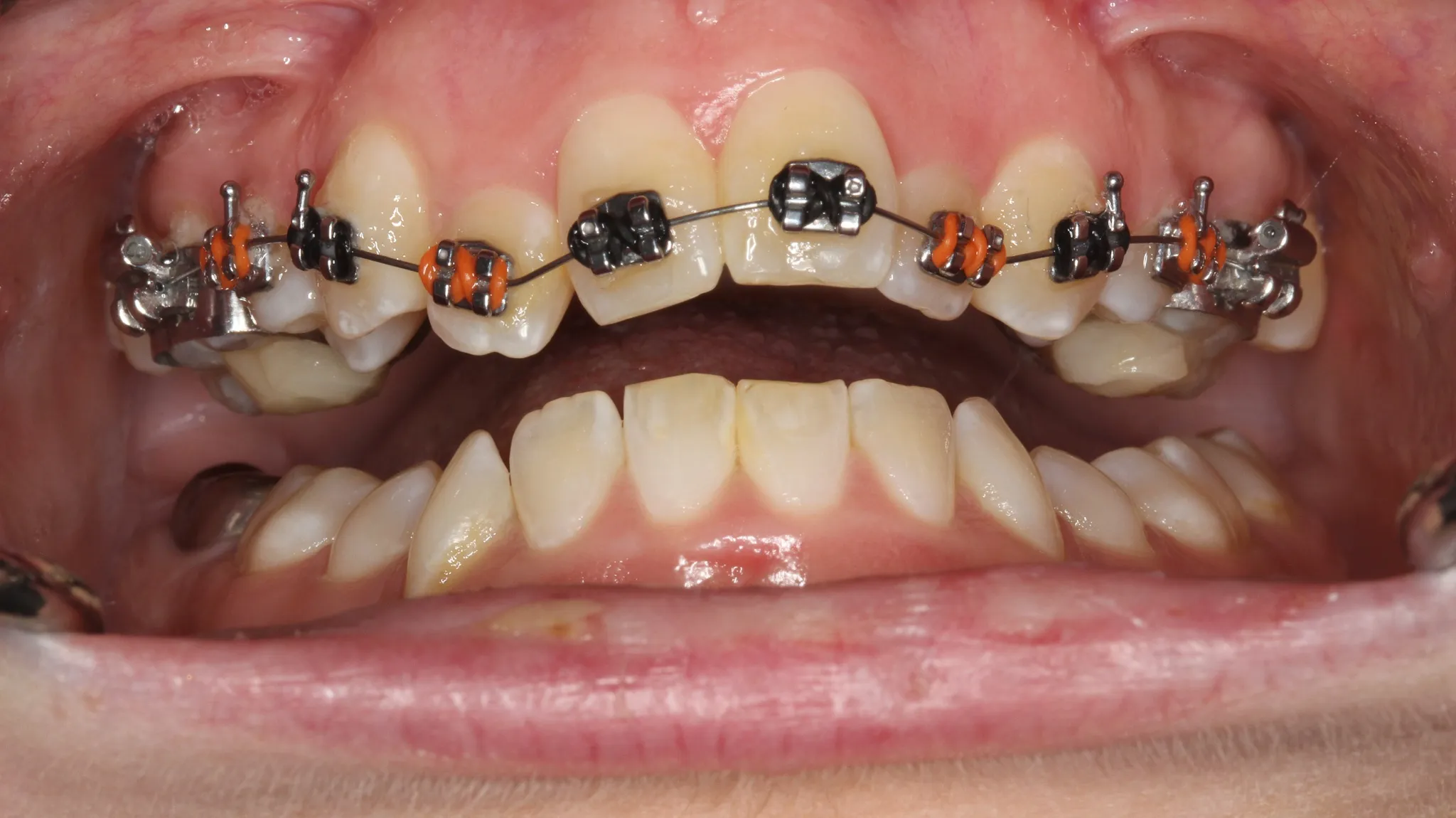 Orthodontic care for TMJ and hypermobility patients