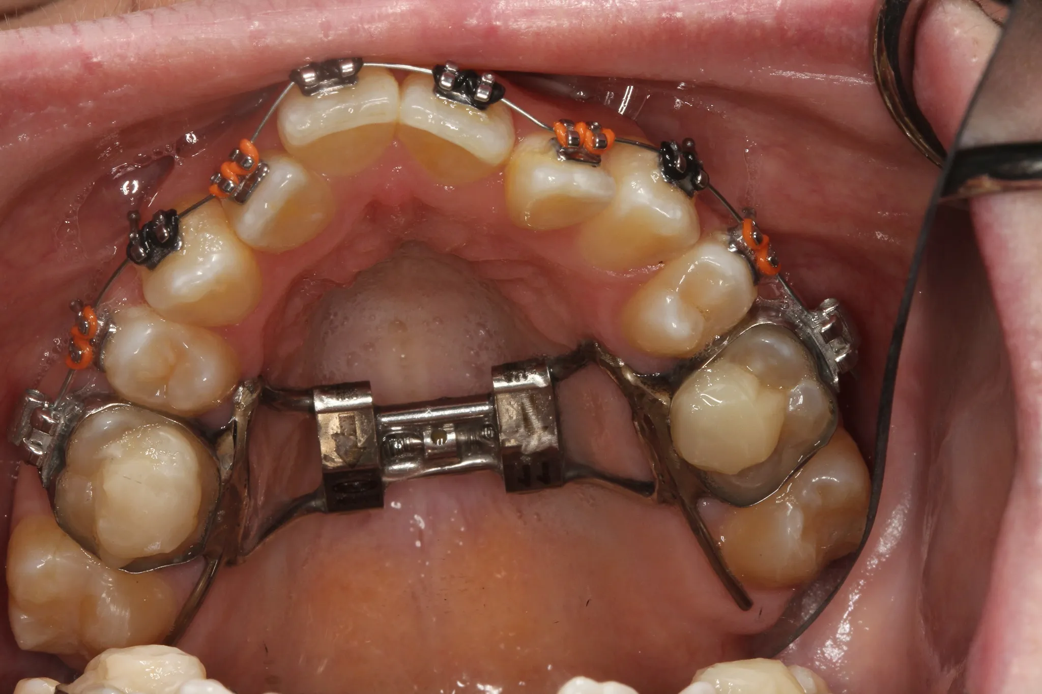 Dental orthopedic appliance for jaw development