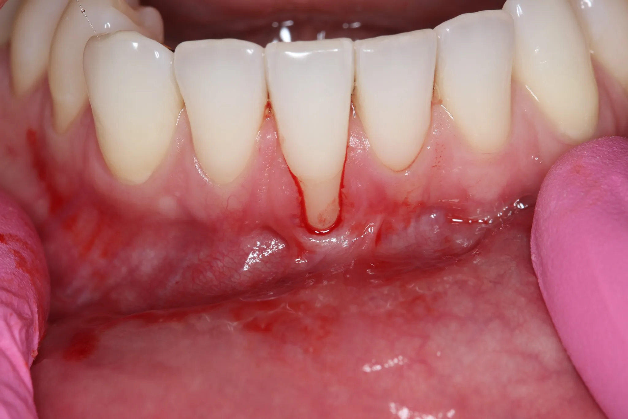 Gum surgery procedure at Bublik Dental