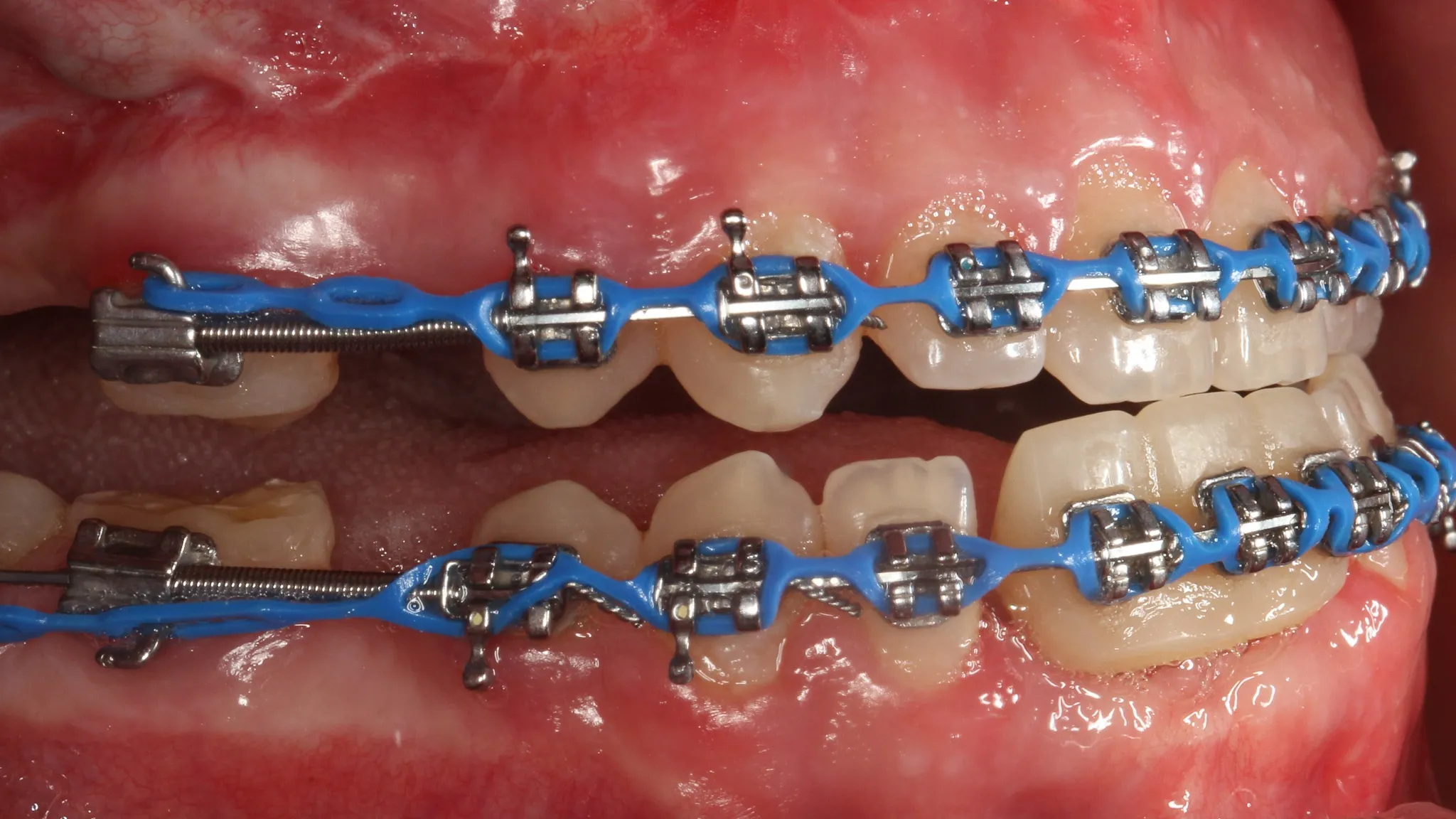 Orthodontic treatment before dental implant placement