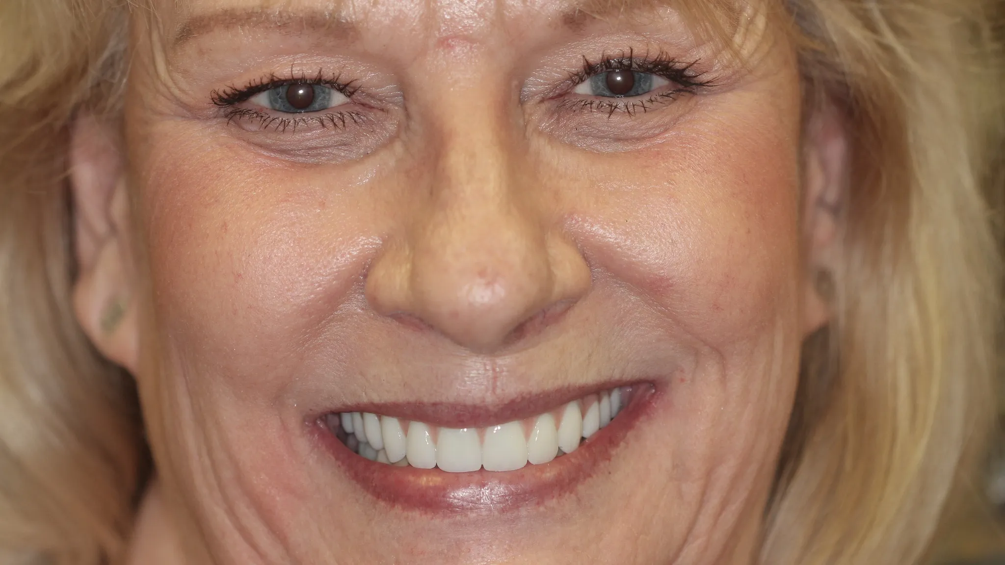 All-on-4 dental implants smile result