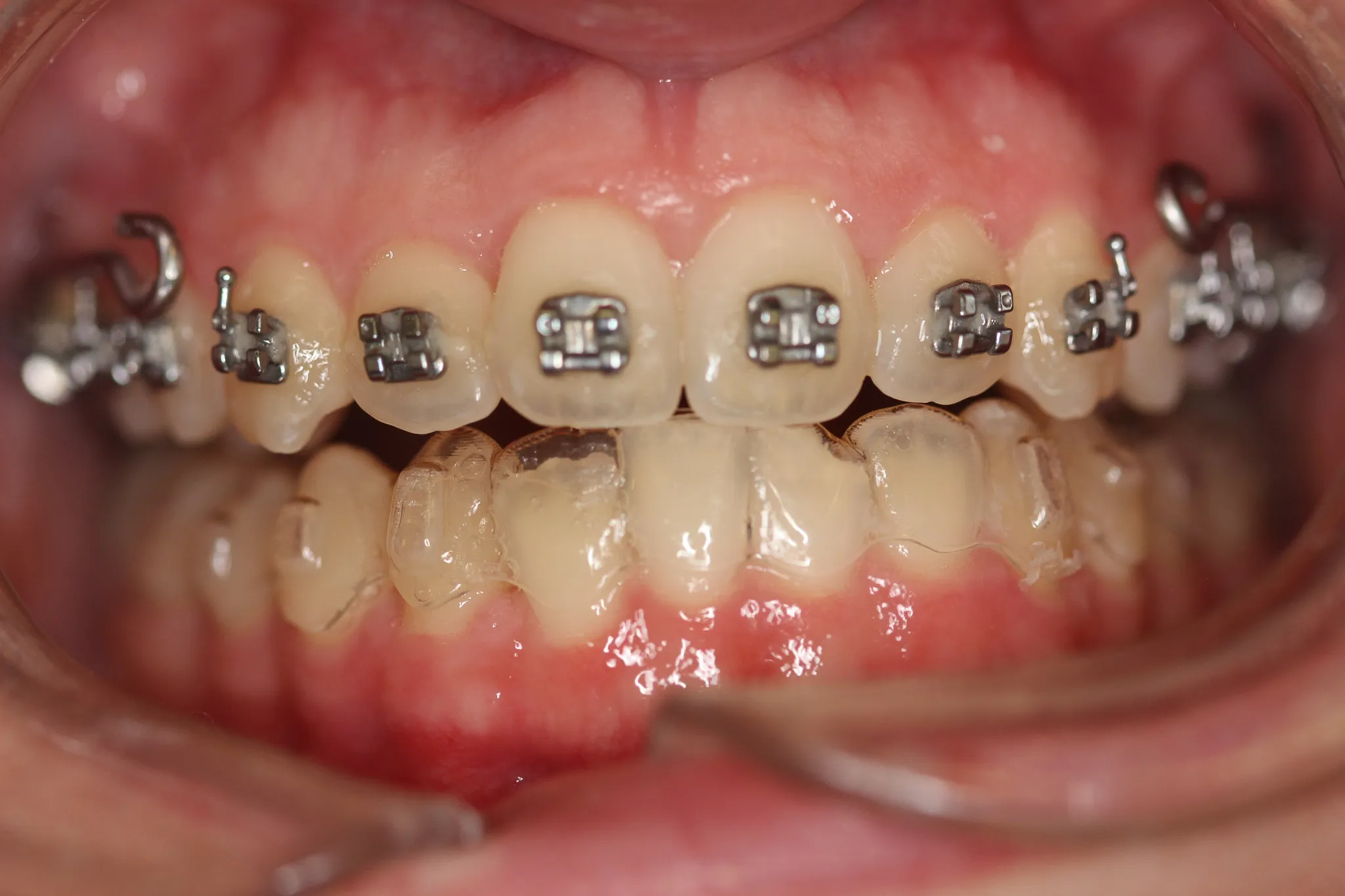 Traditional orthodontic bracket compared to clear aligner