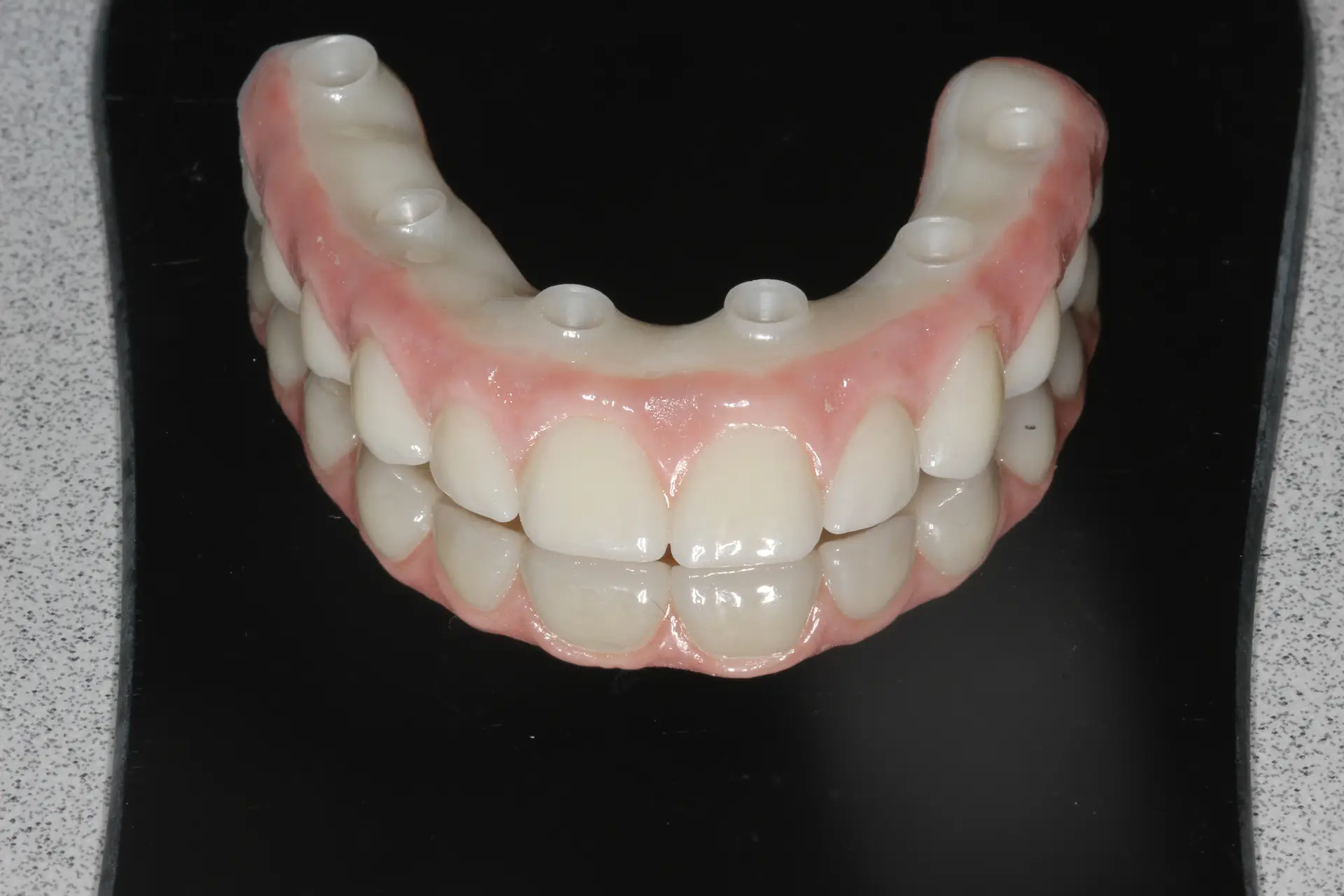 Full arch prosthesis — Bublik Dental