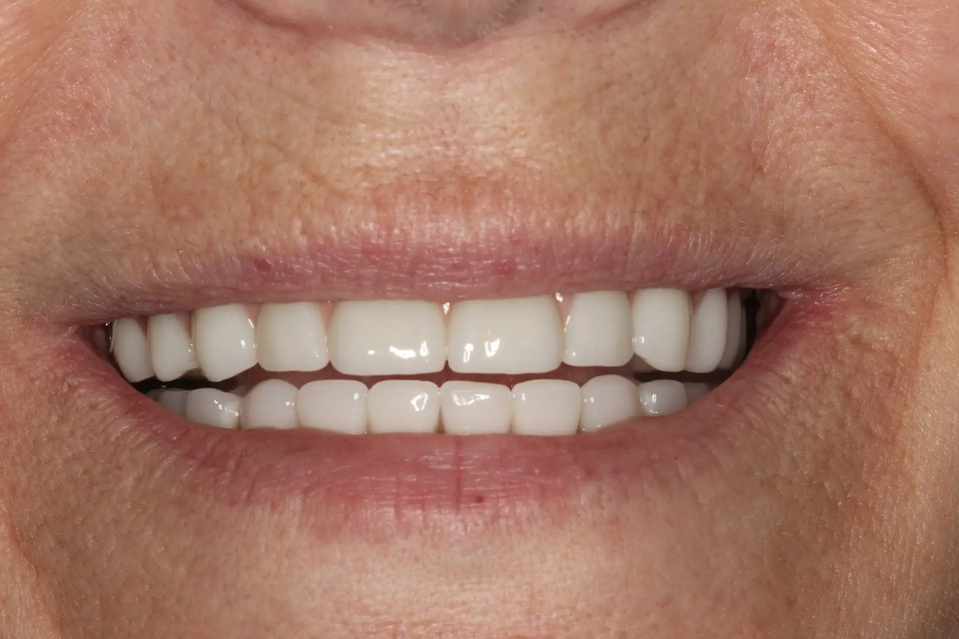 Patient smile after All-on-X — Bublik Dental Wausau