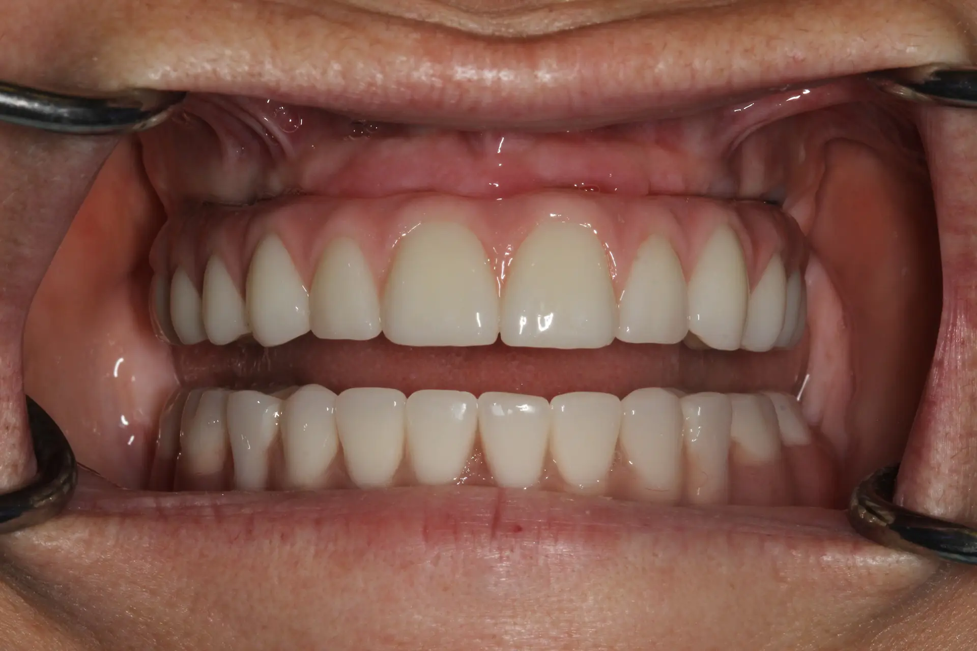 Final intraoral restoration — Bublik Dental